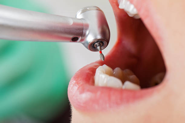 Best Emergency Tooth Extraction in Chase City, VA